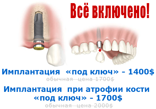 Акции и скидки на имплантацию зубов в Израиле (Тель-Авив)
